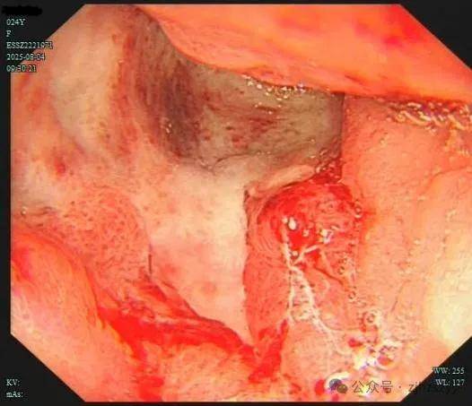 24岁女演员确诊“癌王”，崩溃痛悔：大家别像我这样