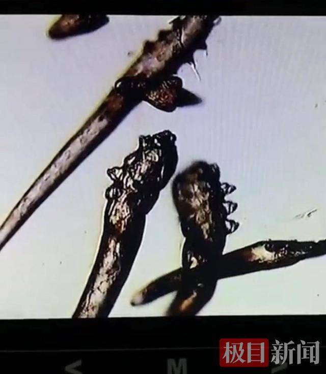 11岁女孩眼痒眼痛,竟是睫毛“养了”10条螨虫!医生:不良生活习惯是帮凶